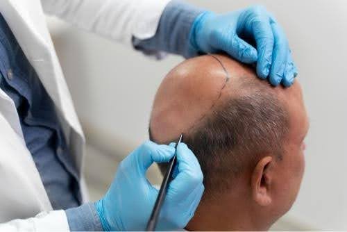 is hair transplant safe